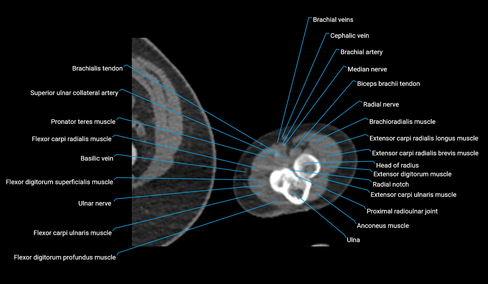 CT upper arm axial  cross sectional anatomy labelled radiology image -00404.webp